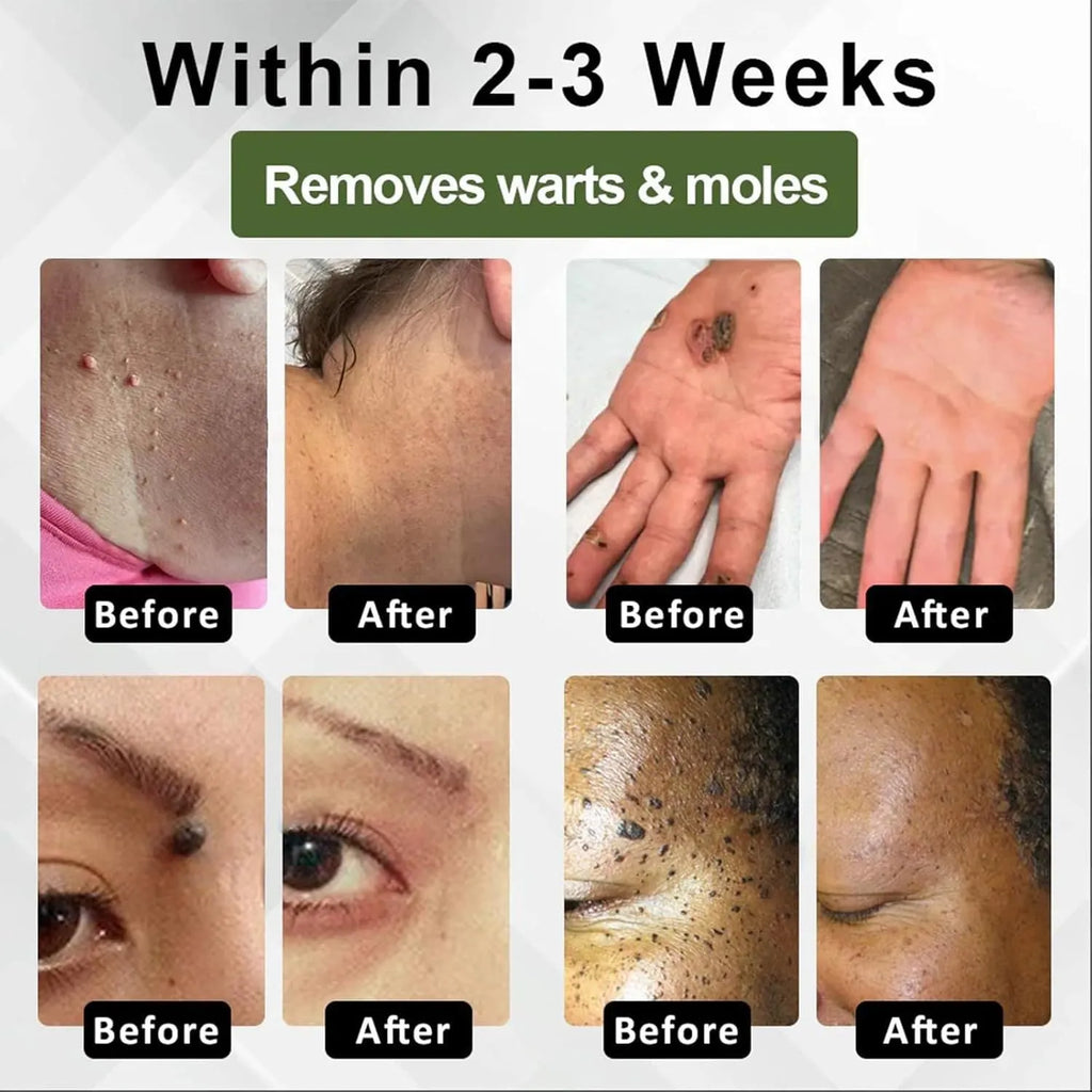 Natureerase Instant Mole Spot Removal Gel 45g hydrating skin treatment product