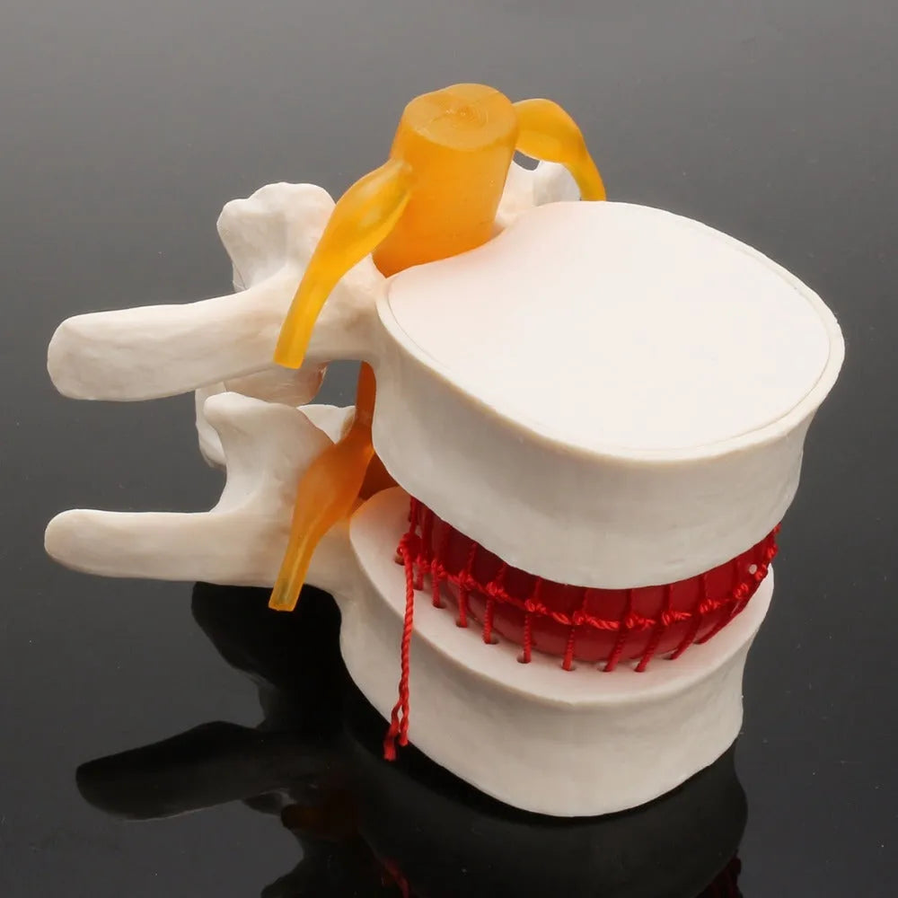 White PVC medical model showing a herniated lumbar intervertebral disc for anatomy education.