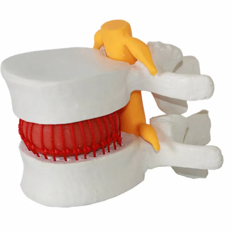 White PVC medical model showing a herniated lumbar intervertebral disc for anatomy education.