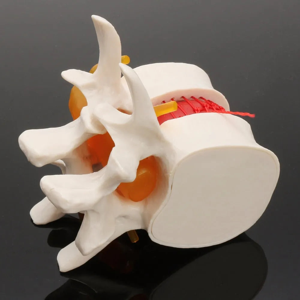White PVC medical model showing a herniated lumbar intervertebral disc for anatomy education.