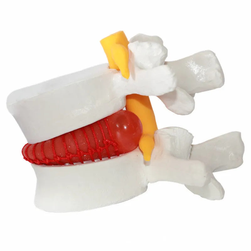 White PVC medical model showing a herniated lumbar intervertebral disc for anatomy education.