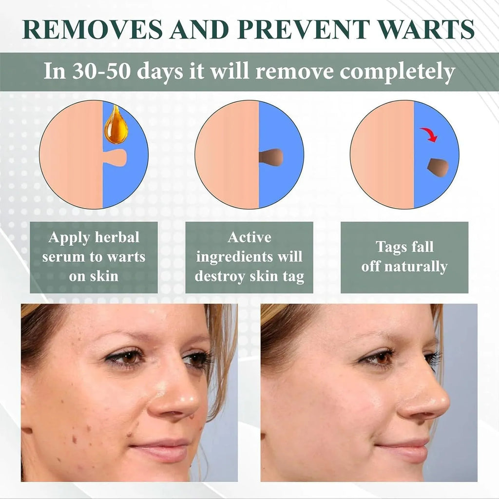 Natureerase Instant Mole Spot Removal Gel 45g hydrating skin treatment product