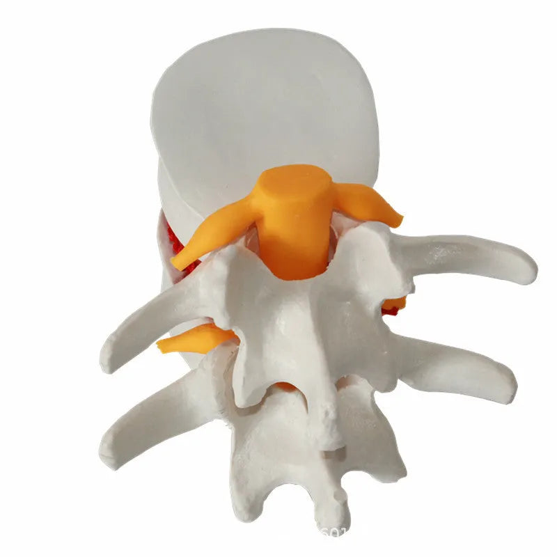 White PVC medical model showing a herniated lumbar intervertebral disc for anatomy education.