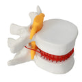 White PVC medical model showing a herniated lumbar intervertebral disc for anatomy education.