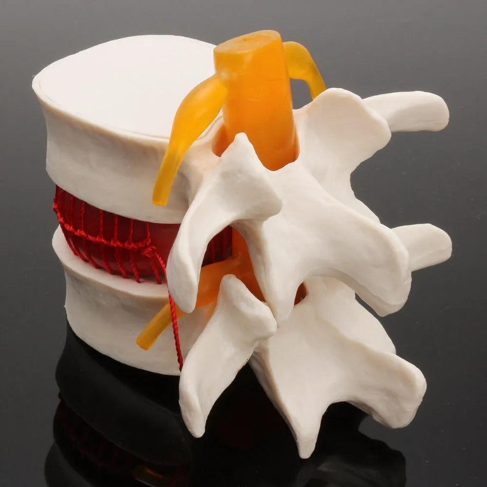 White PVC medical model showing a herniated lumbar intervertebral disc for anatomy education.
