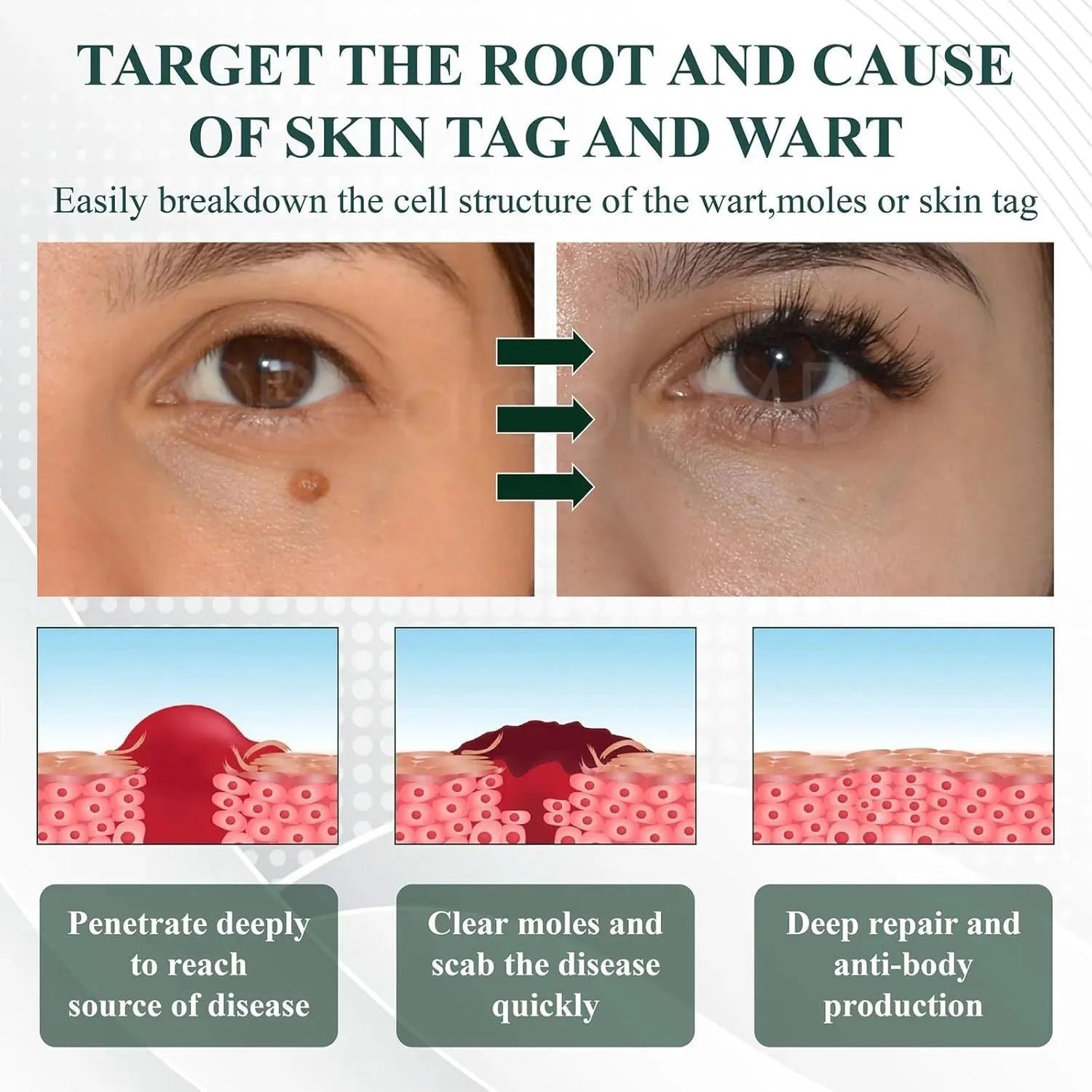 Natureerase Instant Mole Spot Removal Gel 45g hydrating skin treatment product