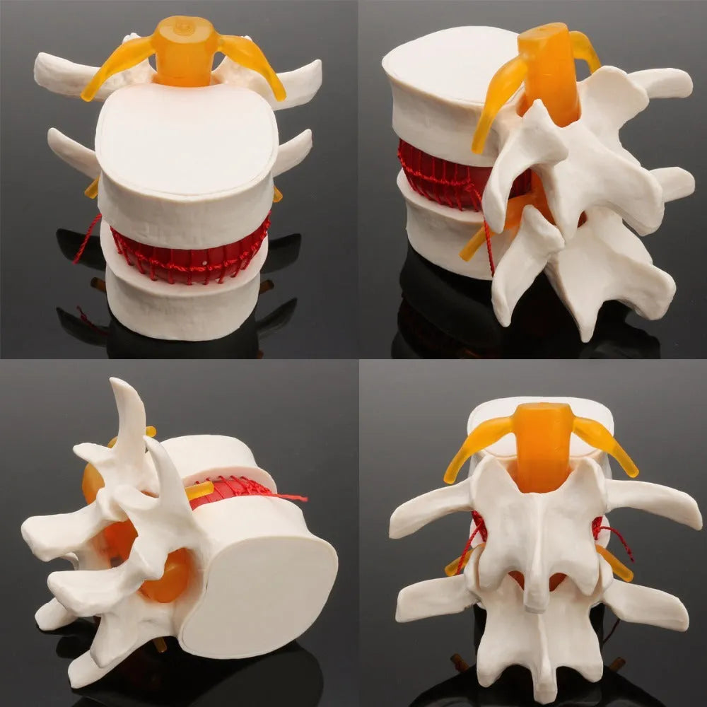 White PVC medical model showing a herniated lumbar intervertebral disc for anatomy education.
